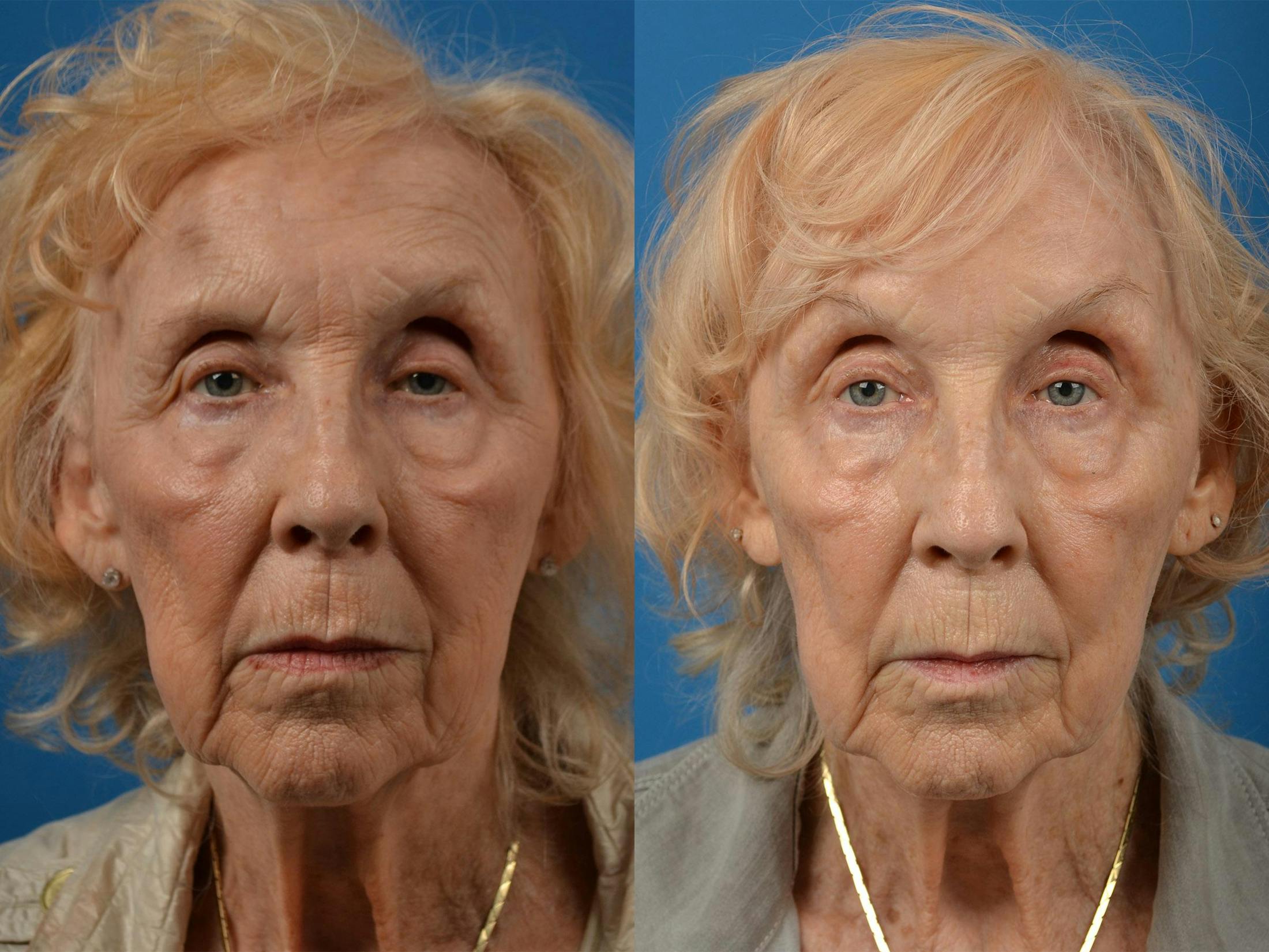 Brow Lift Before & After Gallery - Patient 122405591 - Image 1