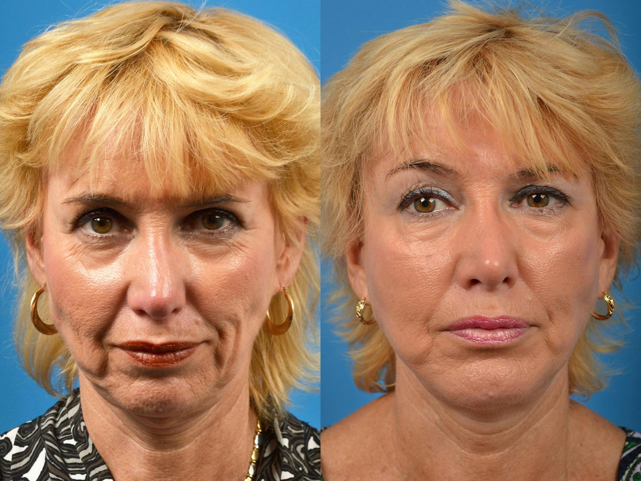 Chin Augmentation Before & After Gallery - Patient 122405584 - Image 3