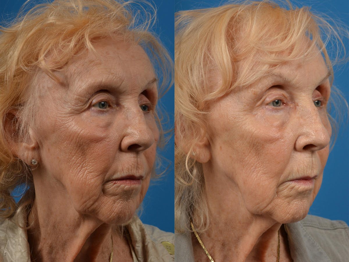 Brow Lift Before & After Gallery - Patient 122405591 - Image 2