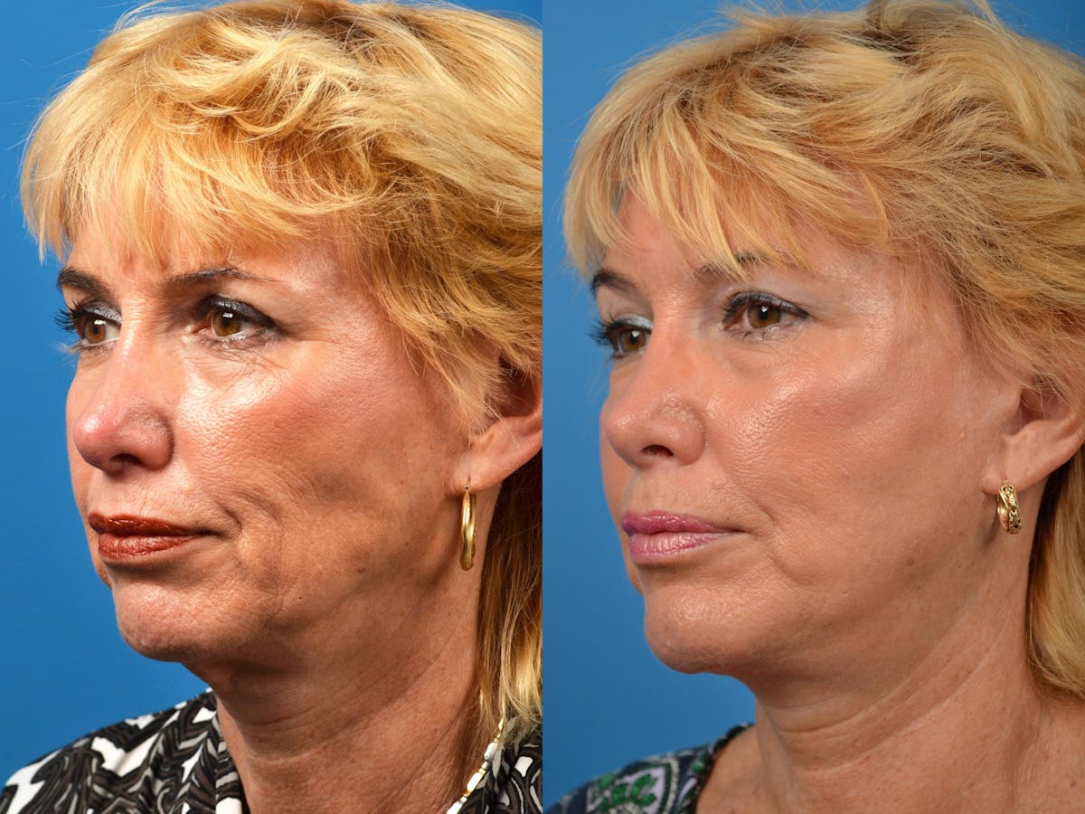 Chin Augmentation Before & After Gallery - Patient 122405584 - Image 4