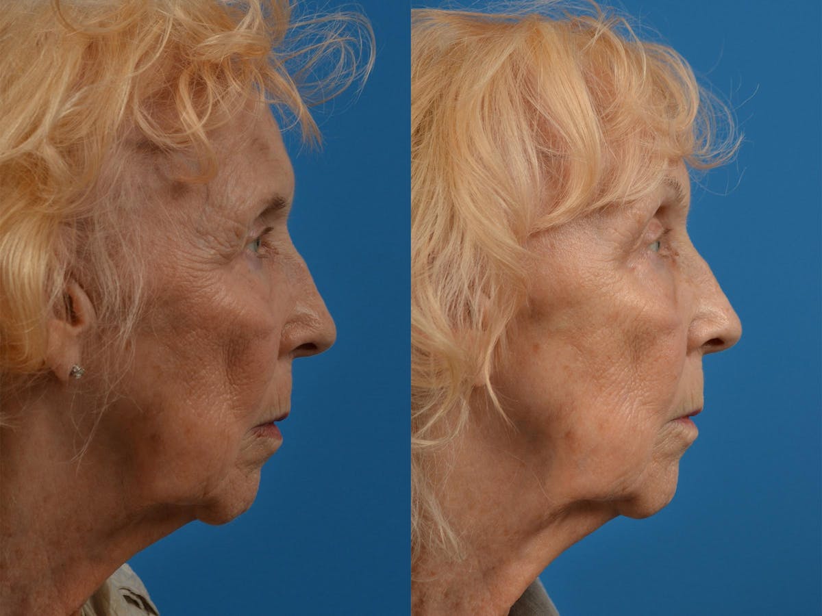 Brow Lift Before & After Gallery - Patient 122405591 - Image 3