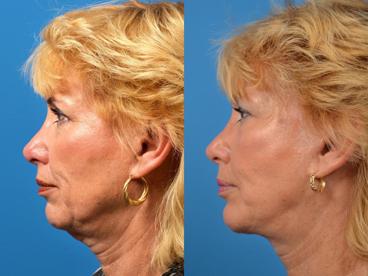 Chin Augmentation Before & After Gallery - Patient 122405584 - Image 5