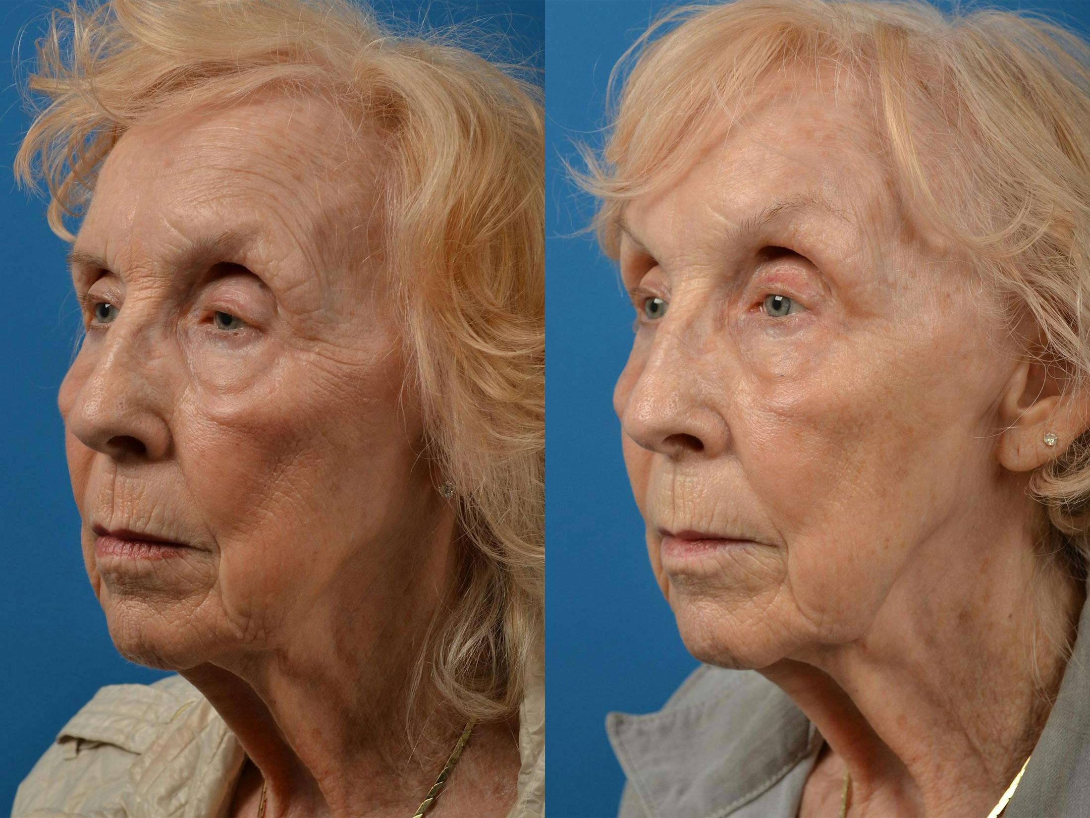Brow Lift Before & After Gallery - Patient 122405591 - Image 4