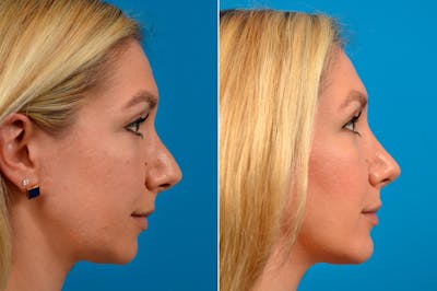 Chin Augmentation Before & After Gallery - Patient 122405592 - Image 1