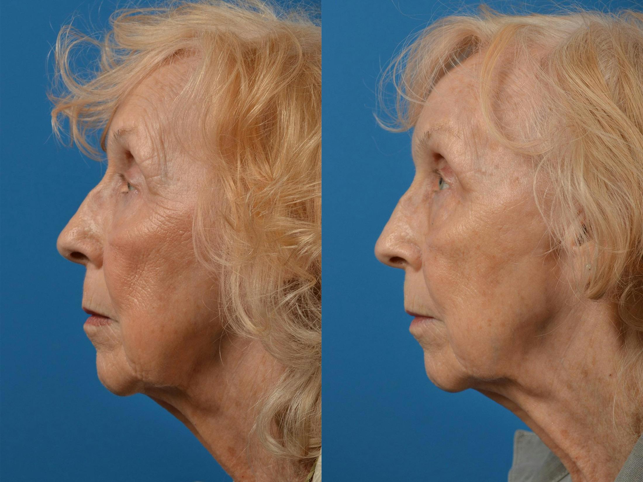 Brow Lift Before & After Gallery - Patient 122405591 - Image 5