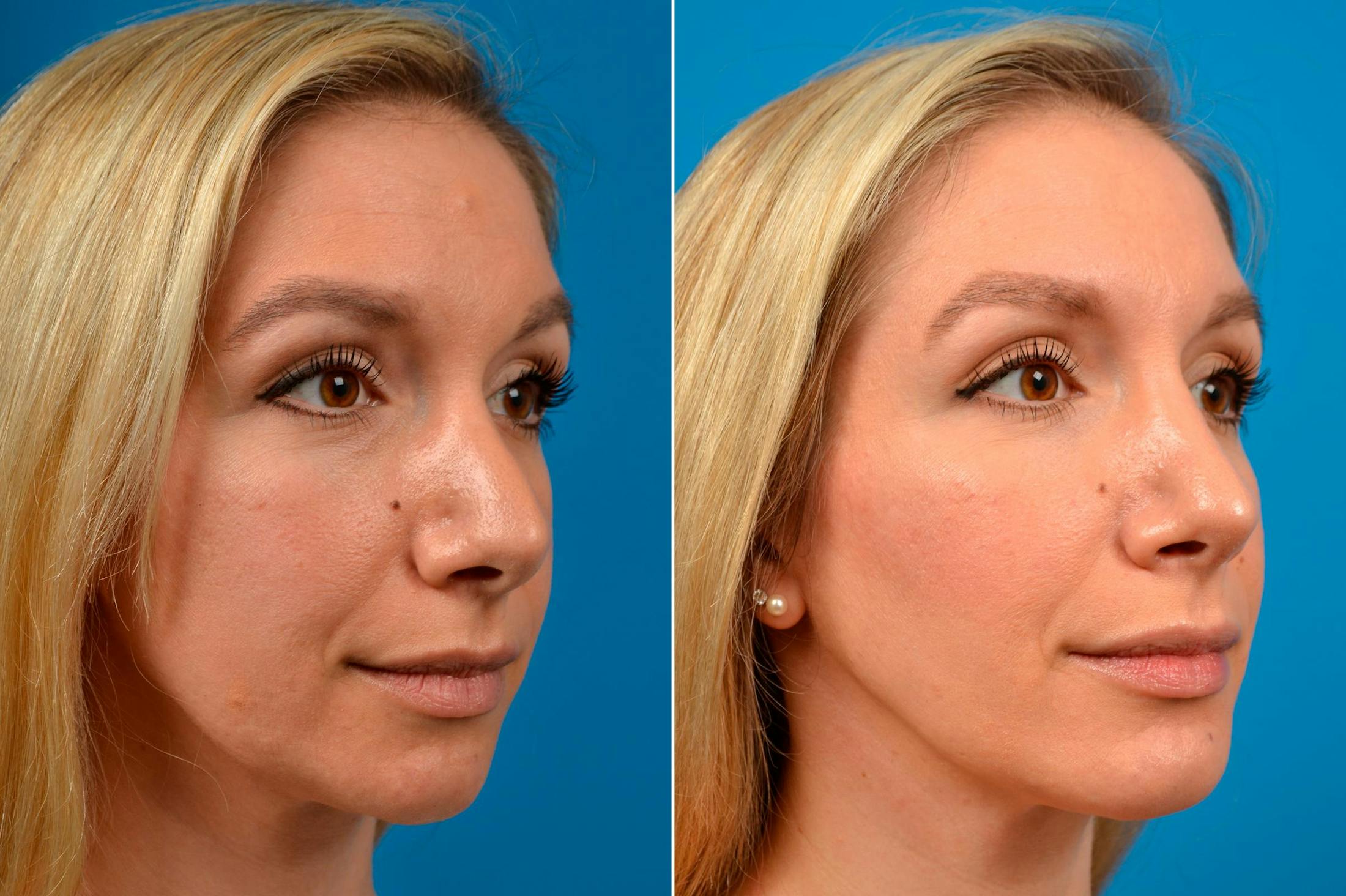 Chin Augmentation Before & After Gallery - Patient 122405592 - Image 2