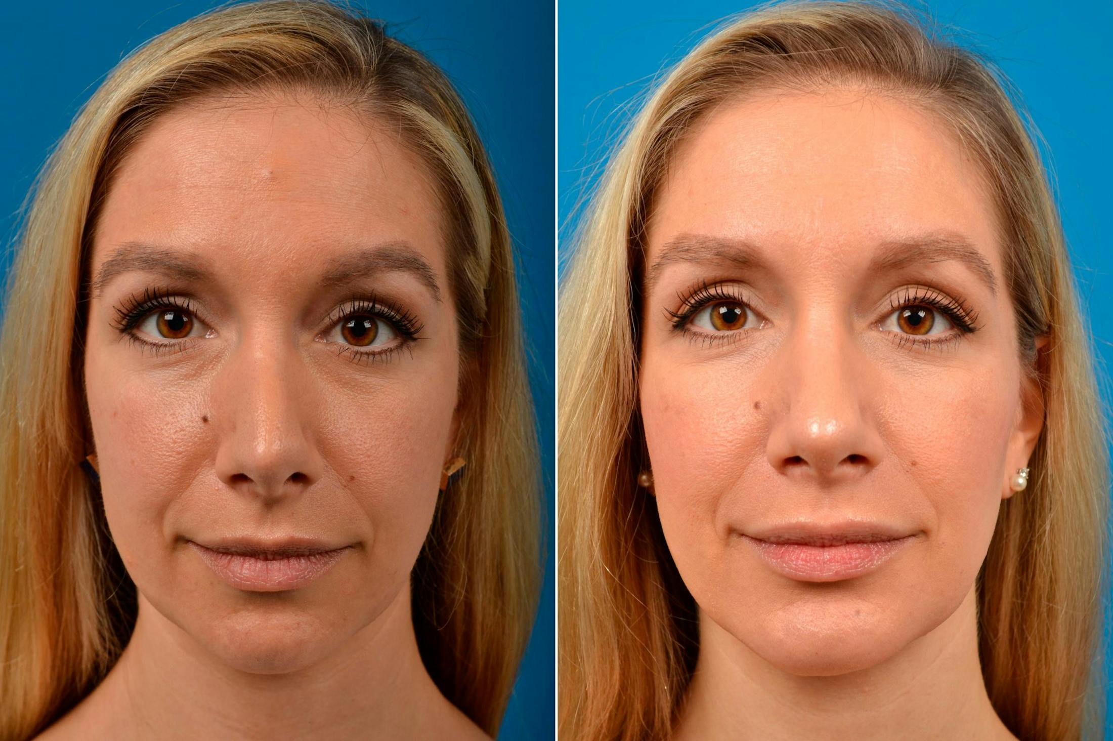 Chin Augmentation Before & After Gallery - Patient 122405592 - Image 3