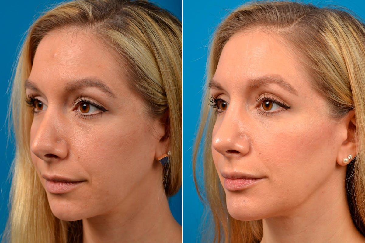 Chin Augmentation Before & After Gallery - Patient 122405592 - Image 4