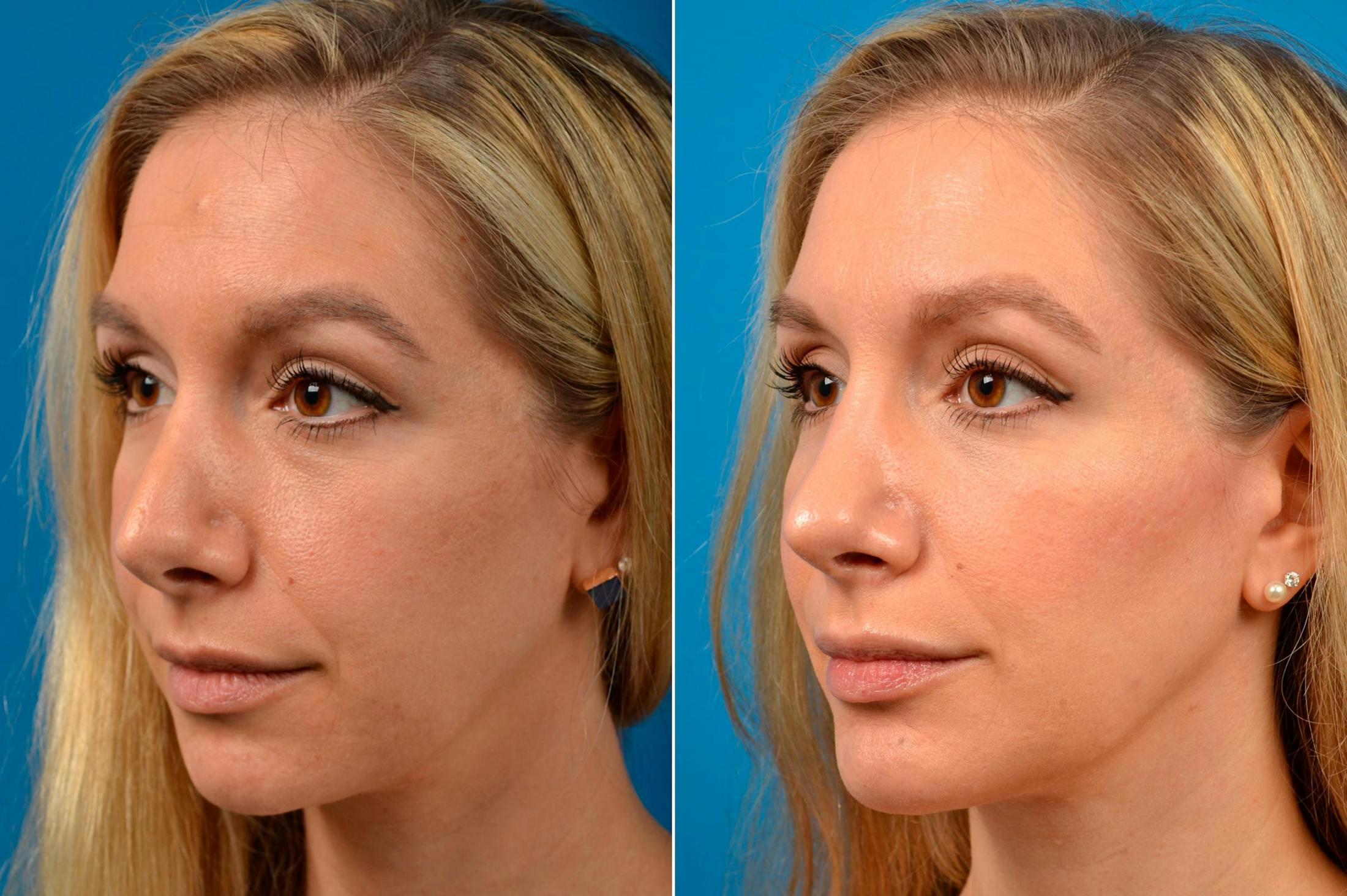 Chin Augmentation Before & After Gallery - Patient 122405592 - Image 4