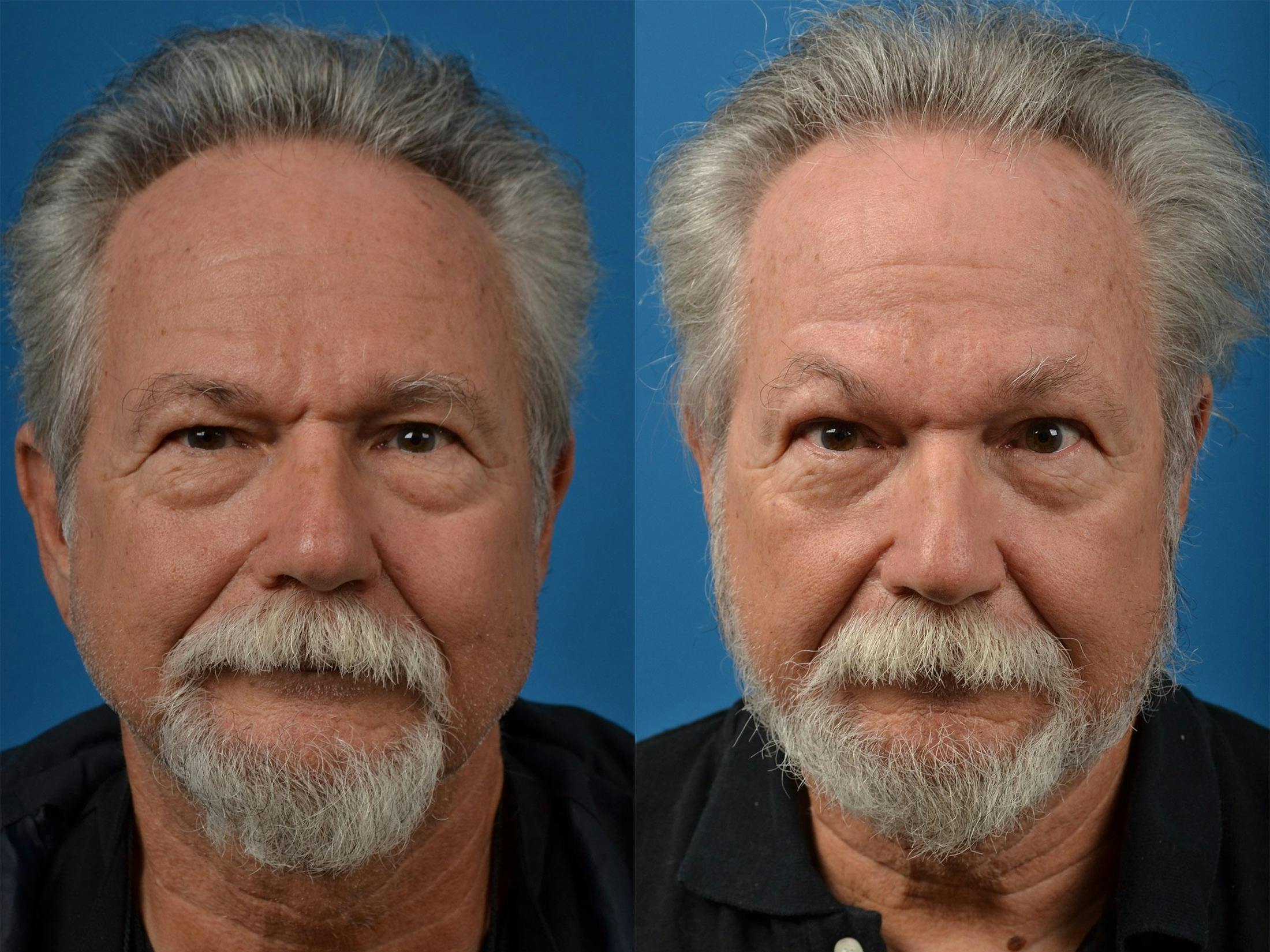 Brow Lift Before & After Gallery - Patient 122405595 - Image 1