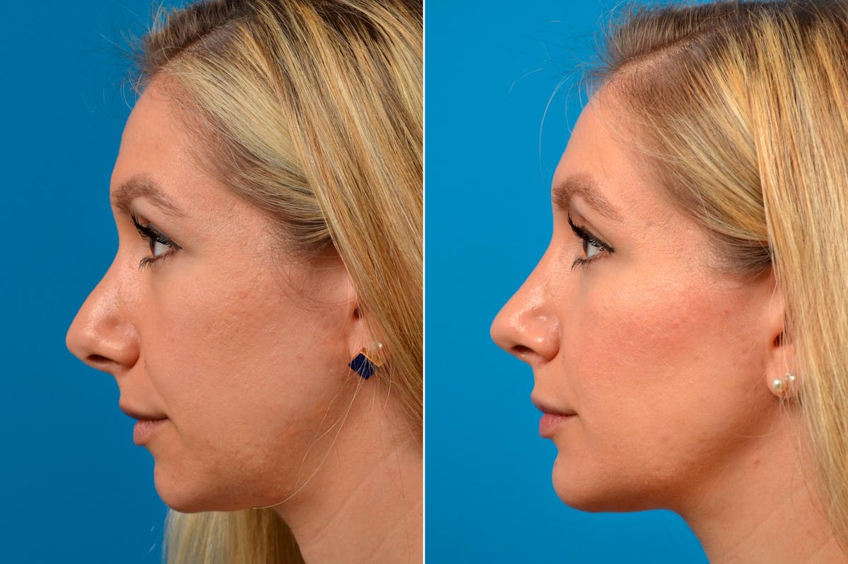 Chin Augmentation Before & After Gallery - Patient 122405592 - Image 5