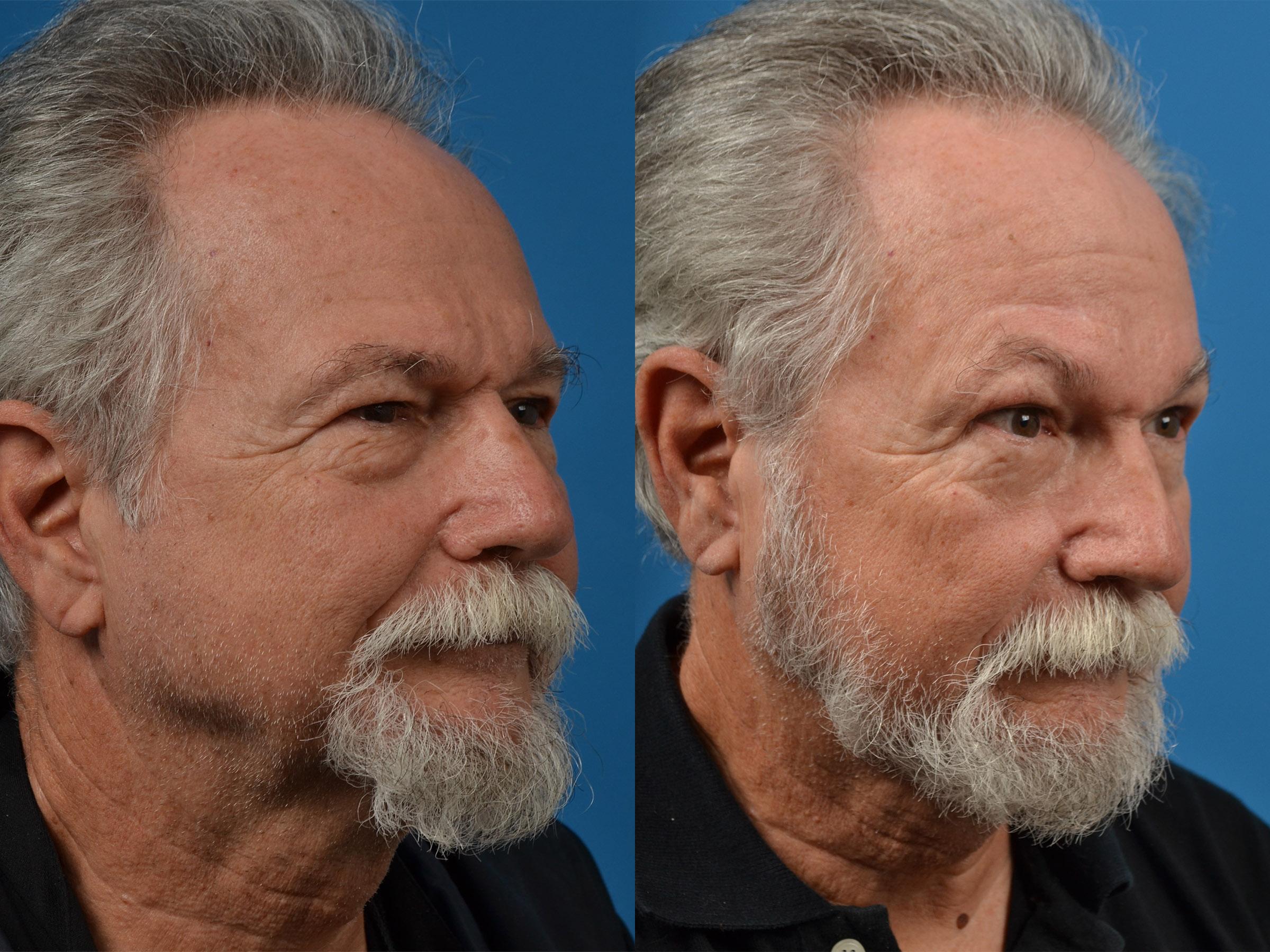 Brow Lift Before & After Gallery - Patient 122405595 - Image 2