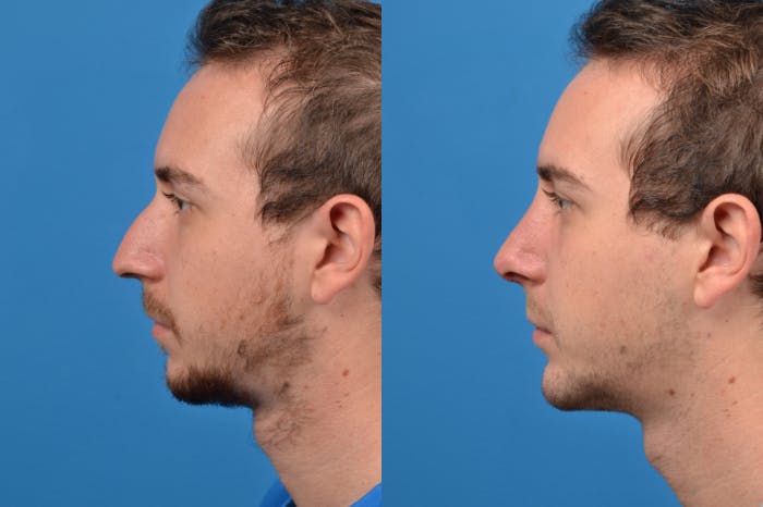Chin Augmentation Before & After Gallery - Patient 122405594 - Image 1