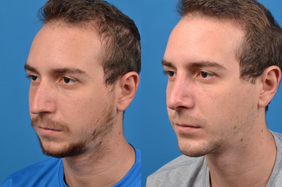 Chin Augmentation Before & After Gallery - Patient 122405594 - Image 2