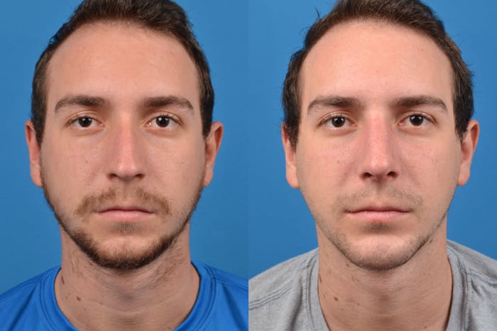 Chin Augmentation Before & After Gallery - Patient 122405594 - Image 3
