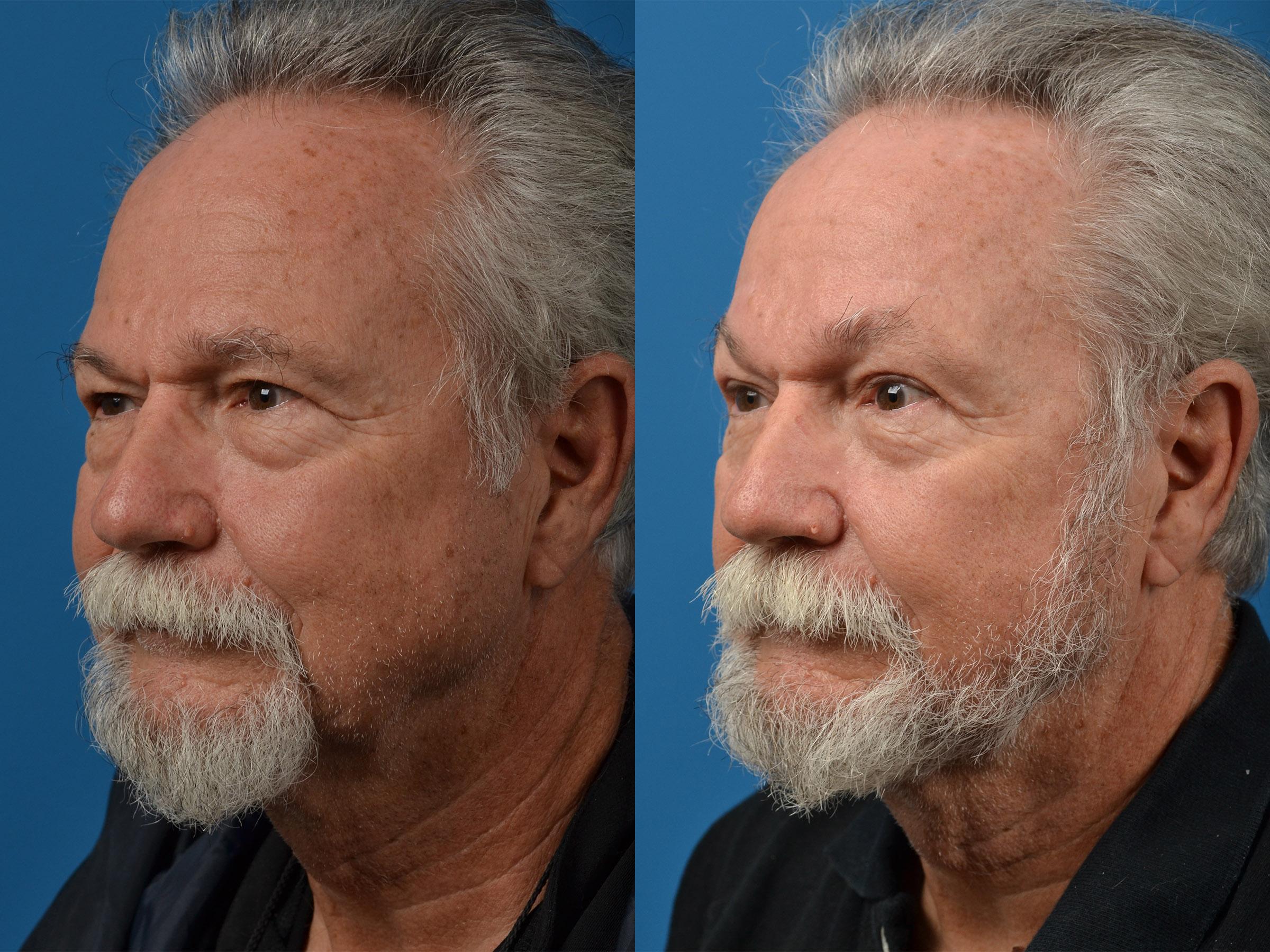 Brow Lift Before & After Gallery - Patient 122405595 - Image 4