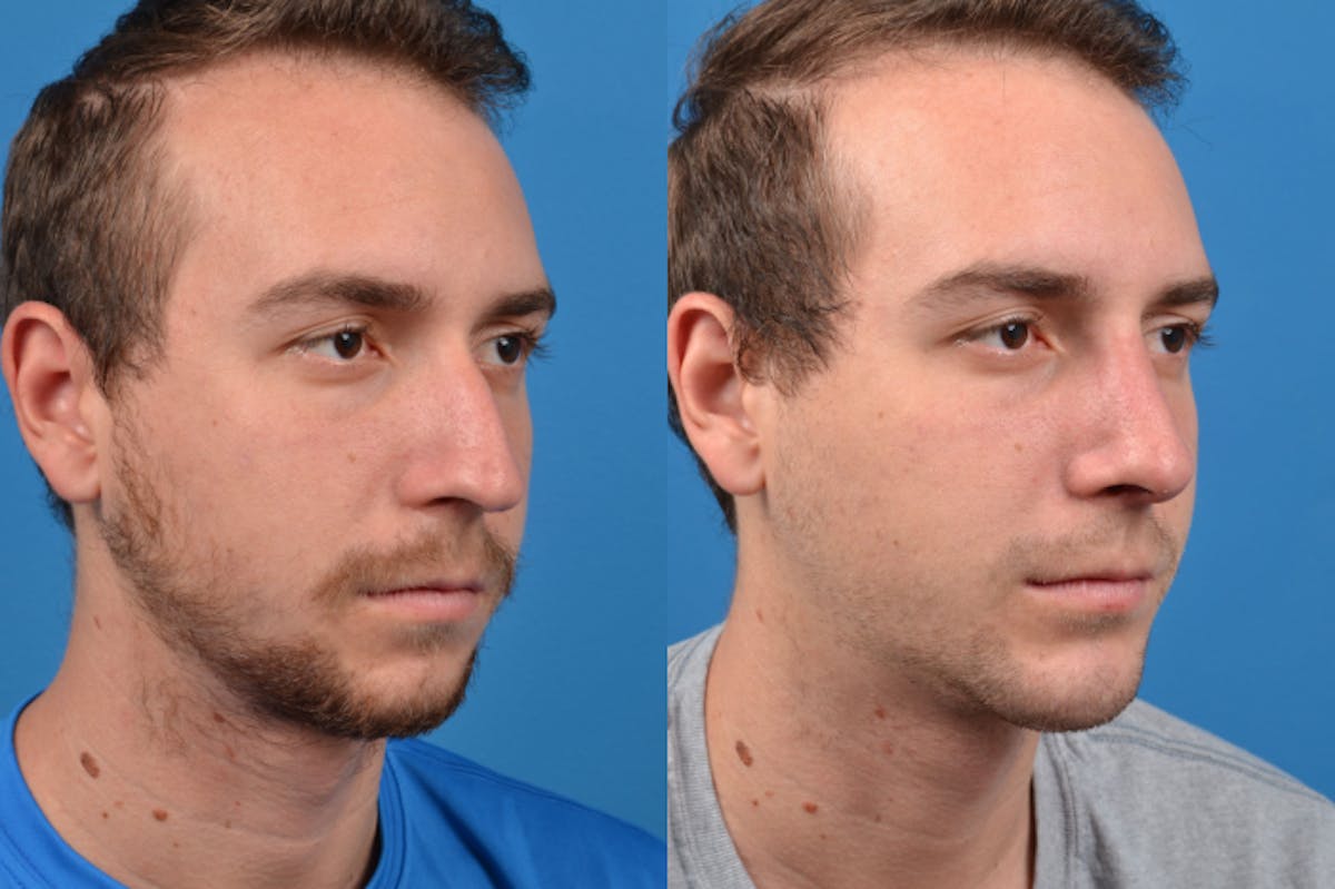 Chin Augmentation Before & After Gallery - Patient 122405594 - Image 4