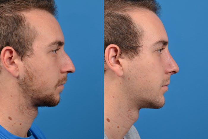 Chin Augmentation Before & After Gallery - Patient 122405594 - Image 5