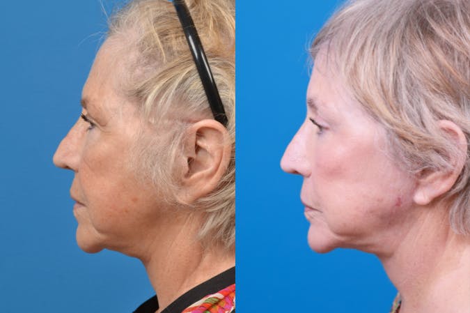 Chin Augmentation Before & After Gallery - Patient 122405596 - Image 1