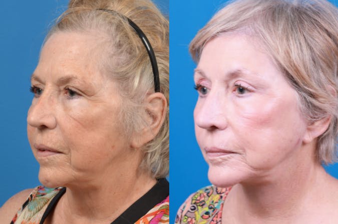 Chin Augmentation Before & After Gallery - Patient 122405596 - Image 2