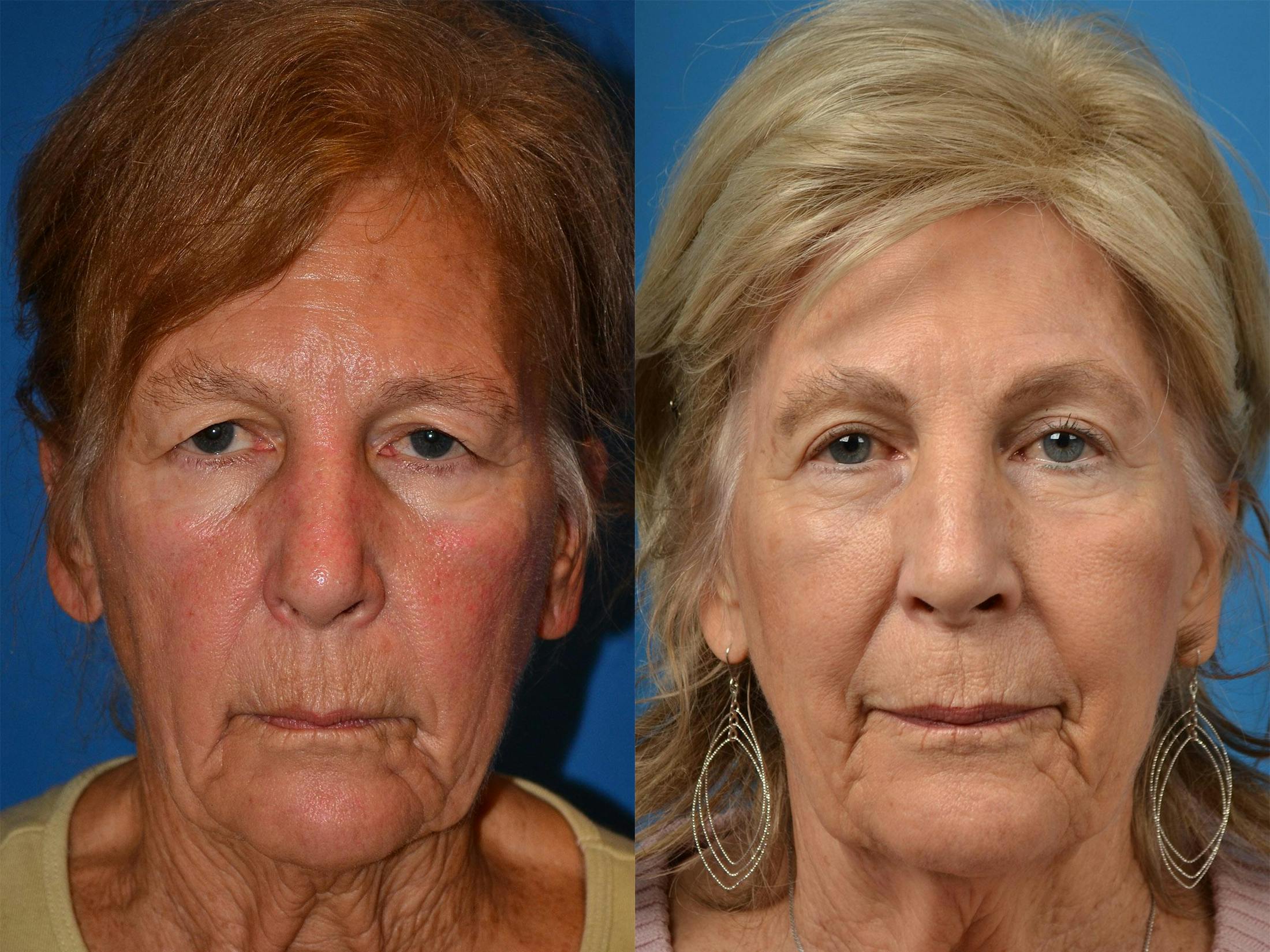 Brow Lift Before & After Gallery - Patient 122405598 - Image 1