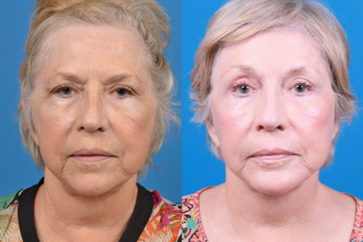 Chin Augmentation Before & After Gallery - Patient 122405596 - Image 3