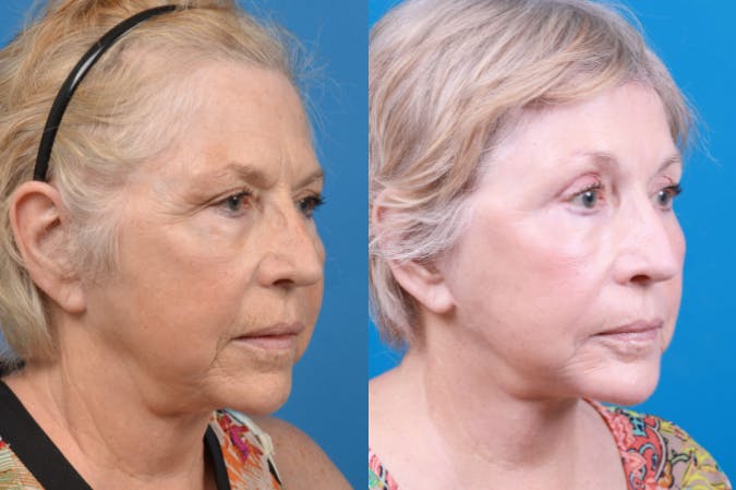 Chin Augmentation Before & After Gallery - Patient 122405596 - Image 4