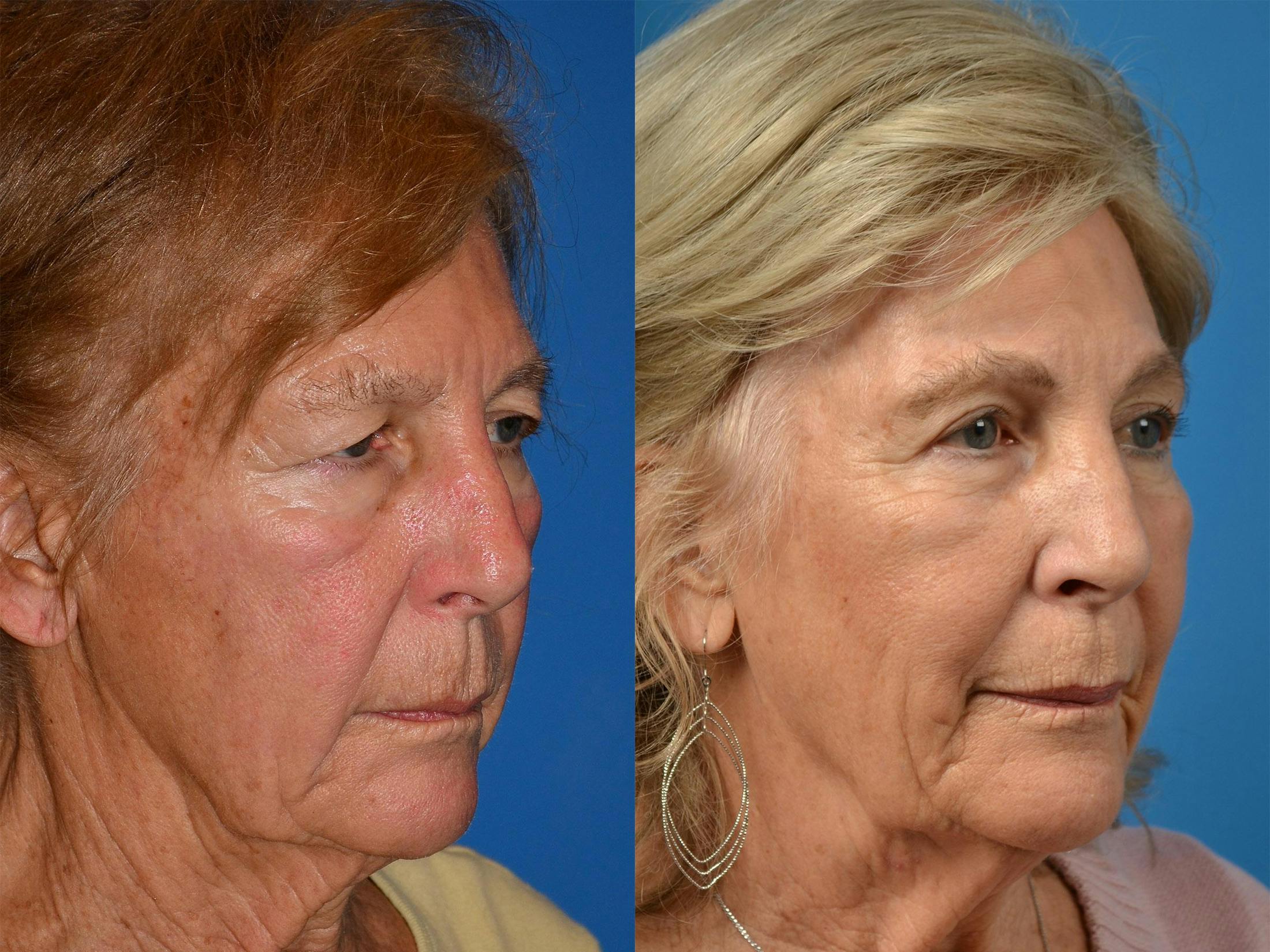 Brow Lift Before & After Gallery - Patient 122405598 - Image 2