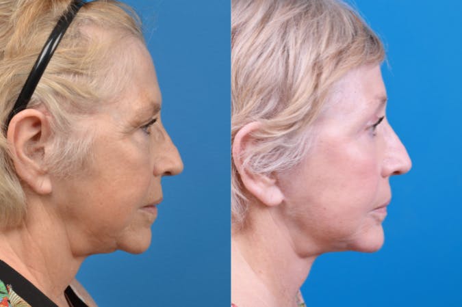 Chin Augmentation Before & After Gallery - Patient 122405596 - Image 5