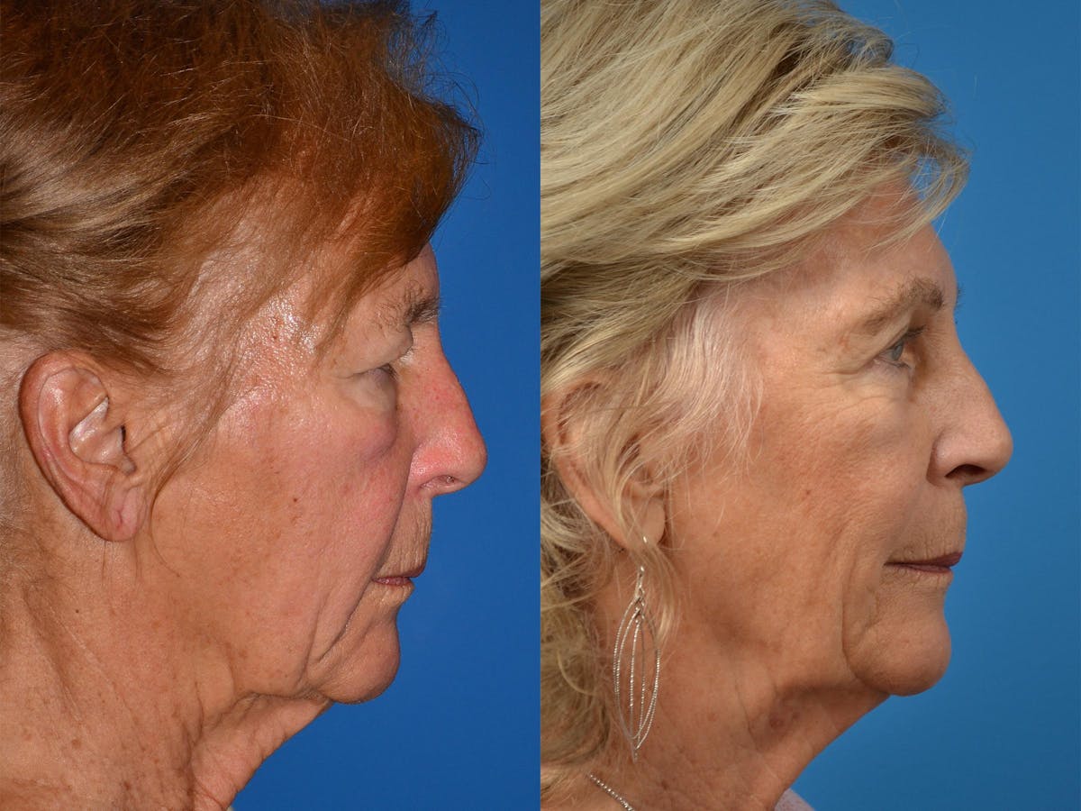 Brow Lift Before & After Gallery - Patient 122405598 - Image 3