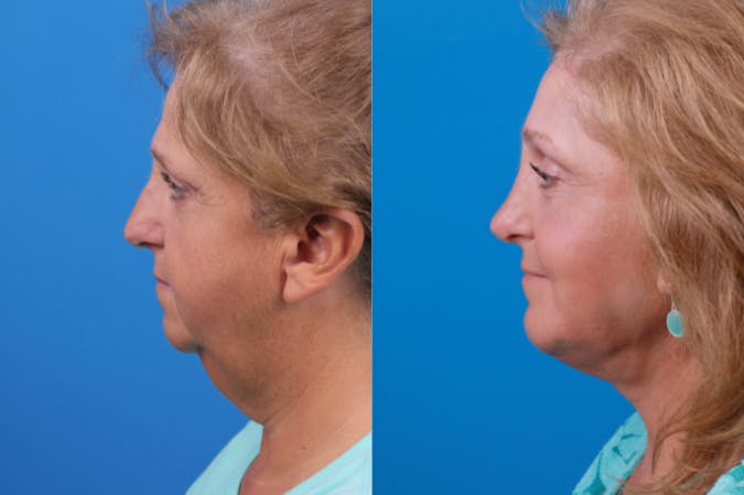 Chin Augmentation Before & After Gallery - Patient 122405597 - Image 1