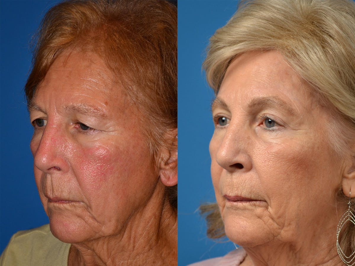 Brow Lift Before & After Gallery - Patient 122405598 - Image 4