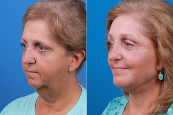 Chin Augmentation Before & After Gallery - Patient 122405597 - Image 2
