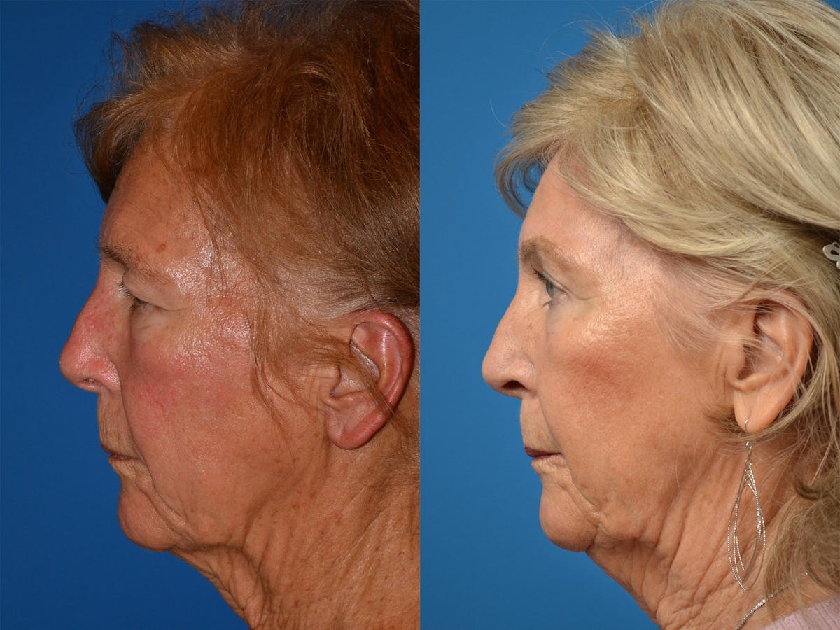Brow Lift Before & After Gallery - Patient 122405598 - Image 5