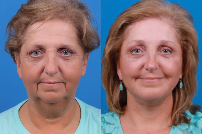Chin Augmentation Before & After Gallery - Patient 122405597 - Image 3