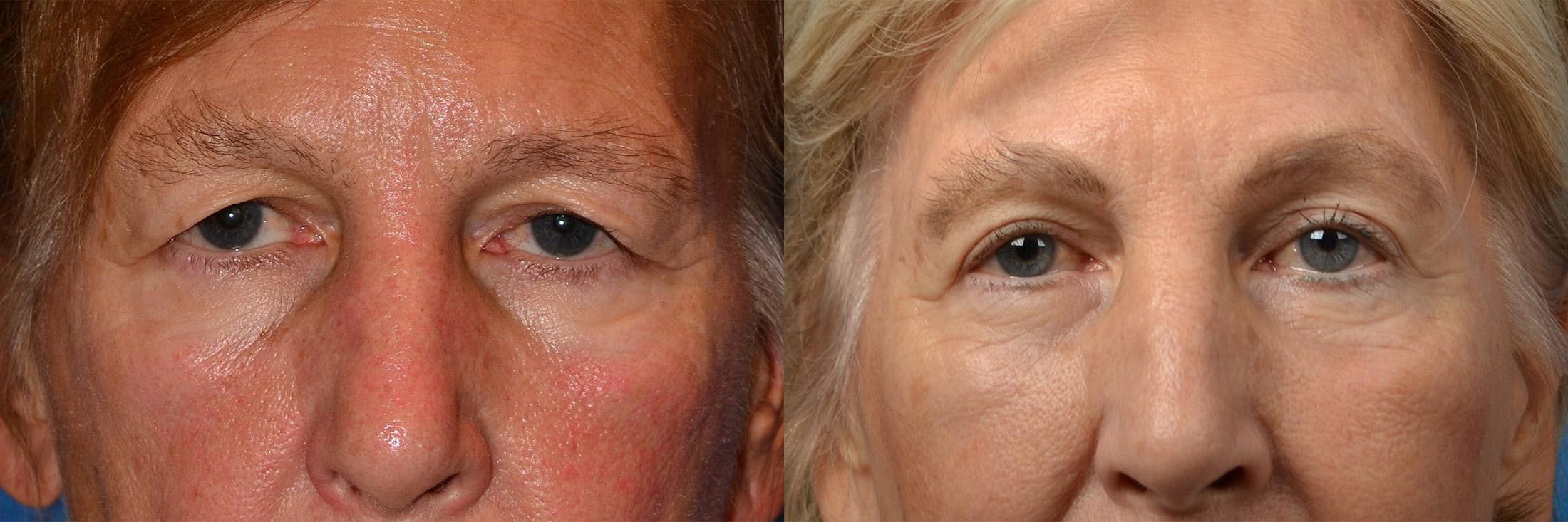 Brow Lift Before & After Gallery - Patient 122405598 - Image 6