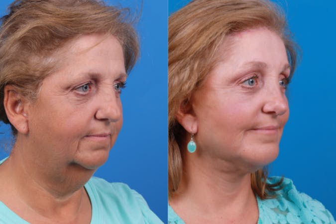 Chin Augmentation Before & After Gallery - Patient 122405597 - Image 4