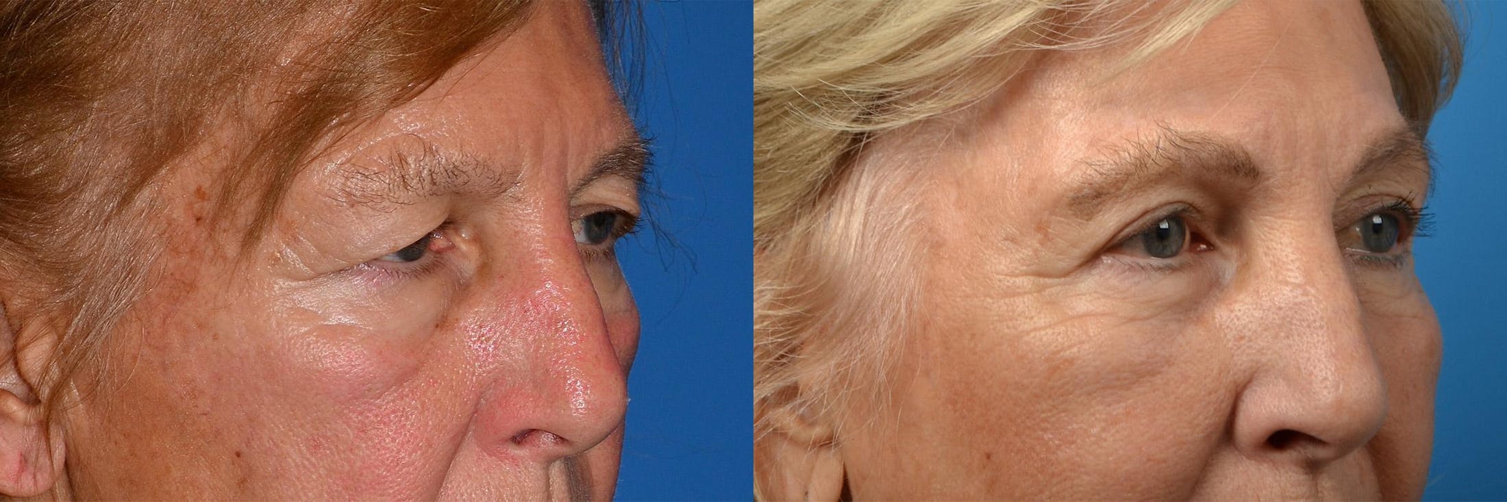 Brow Lift Before & After Gallery - Patient 122405598 - Image 7