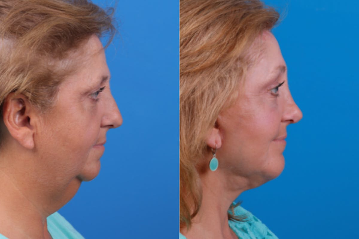Chin Augmentation Before & After Gallery - Patient 122405597 - Image 5