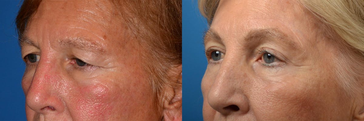 Brow Lift Before & After Gallery - Patient 122405598 - Image 8