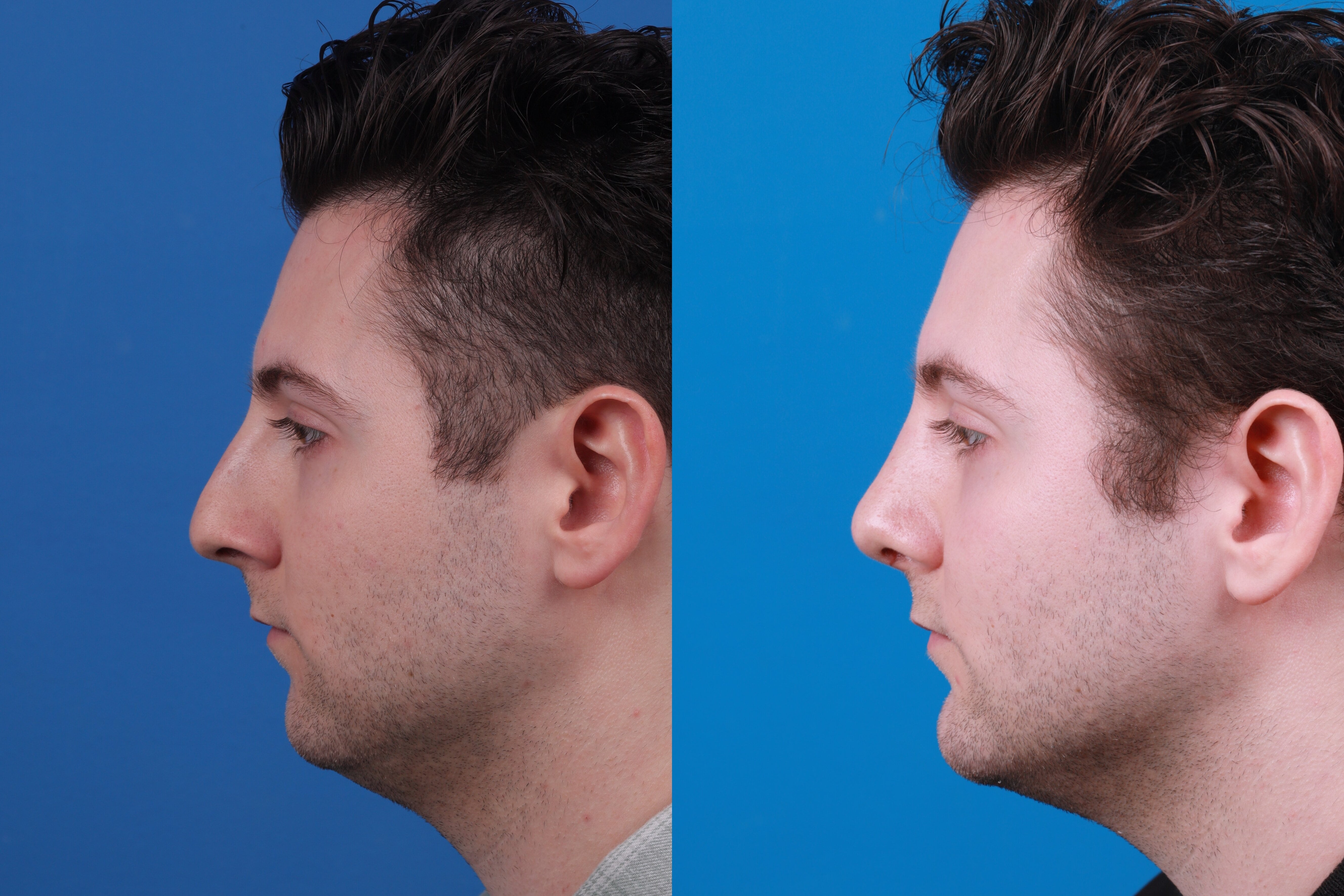 Chin Augmentation Before & After Gallery - Patient 122405600 - Image 5