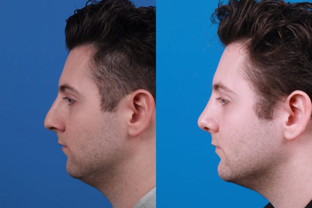 Chin Augmentation Before & After Gallery - Patient 122405600 - Image 5
