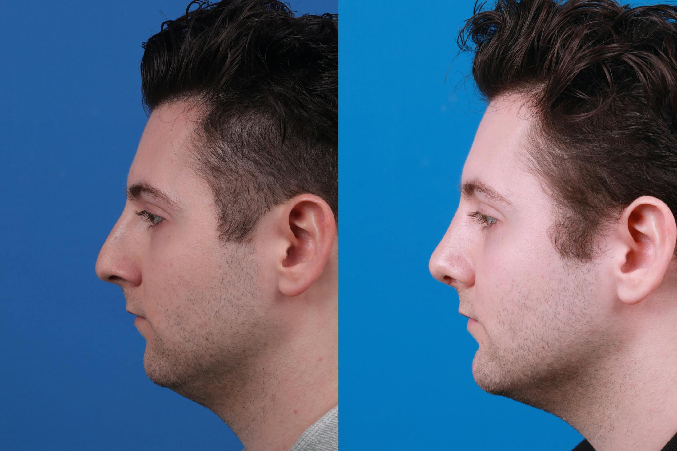 Chin Augmentation Before & After Gallery - Patient 122405600 - Image 2