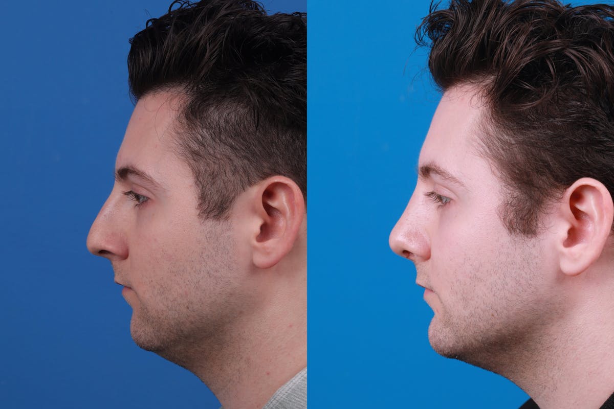 Chin Augmentation Before & After Gallery - Patient 122405600 - Image 2