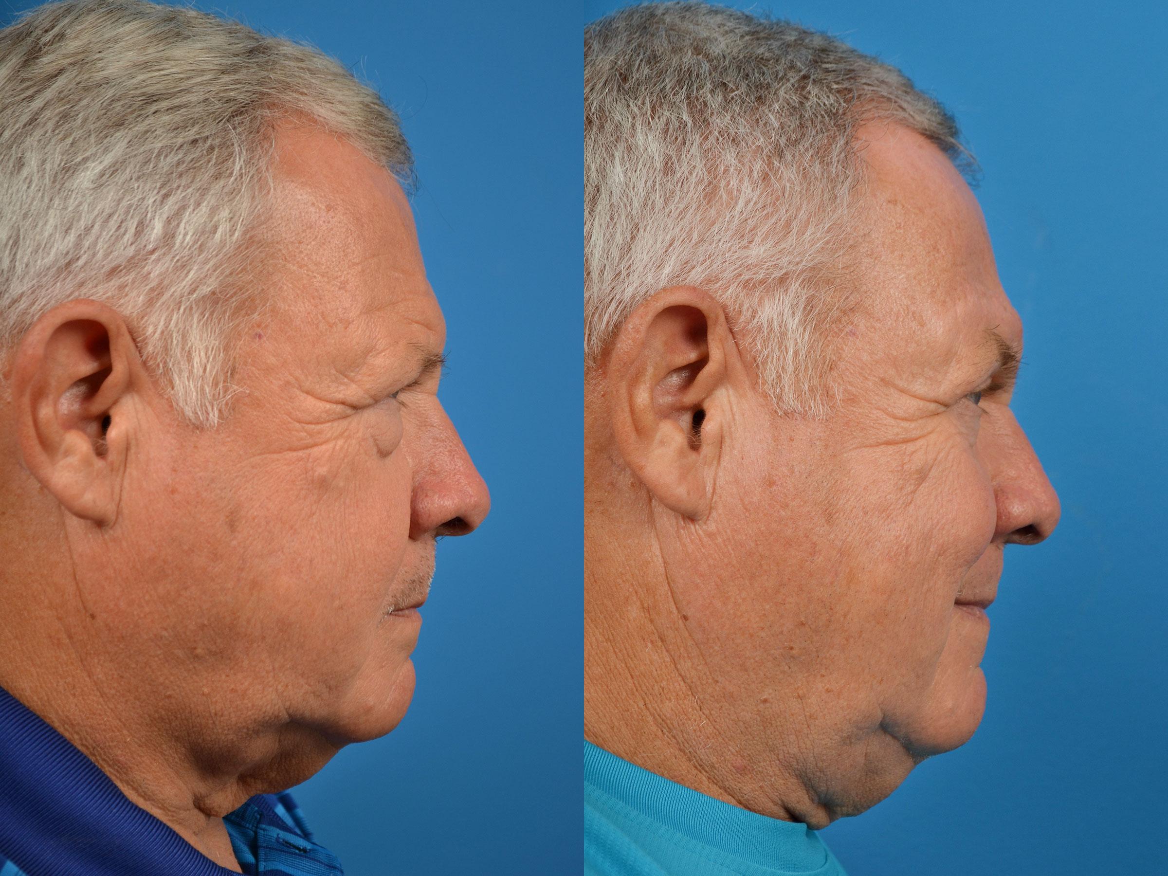 Brow Lift Before & After Gallery - Patient 122405599 - Image 3