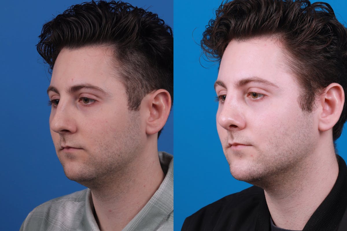 Chin Augmentation Before & After Gallery - Patient 122405600 - Image 4