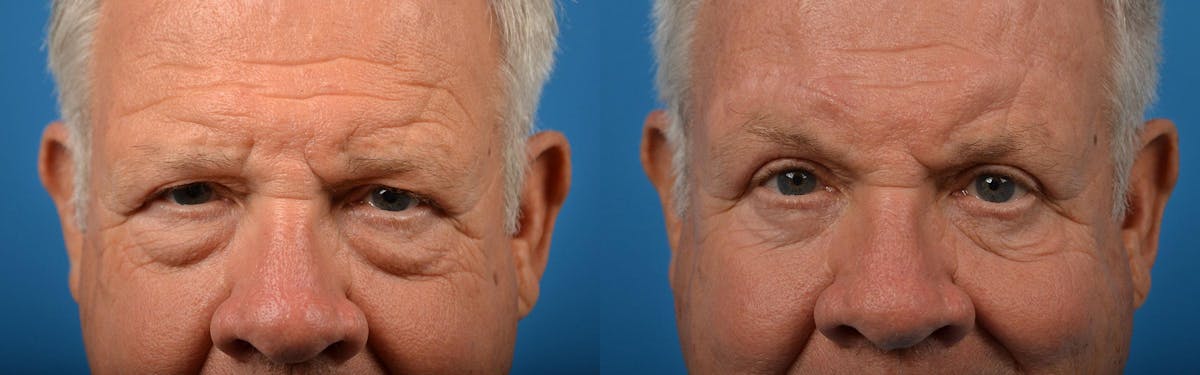 Brow Lift Before & After Gallery - Patient 122405599 - Image 6