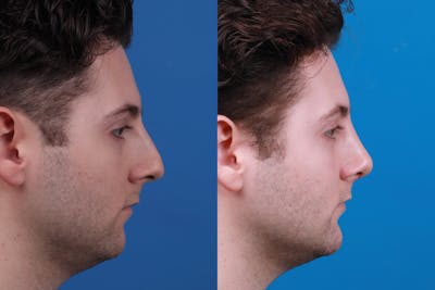 Chin Augmentation Before & After Gallery - Patient 122405600 - Image 1