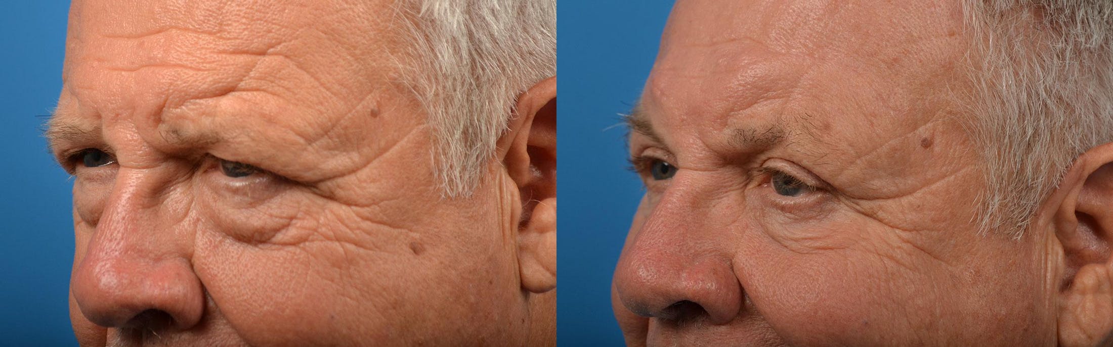 Brow Lift Before & After Gallery - Patient 122405599 - Image 8