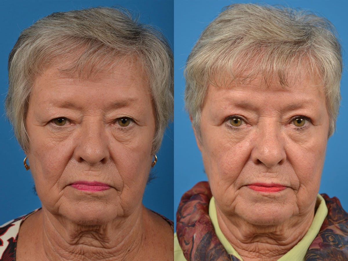 Brow Lift Before & After Gallery - Patient 122405601 - Image 1